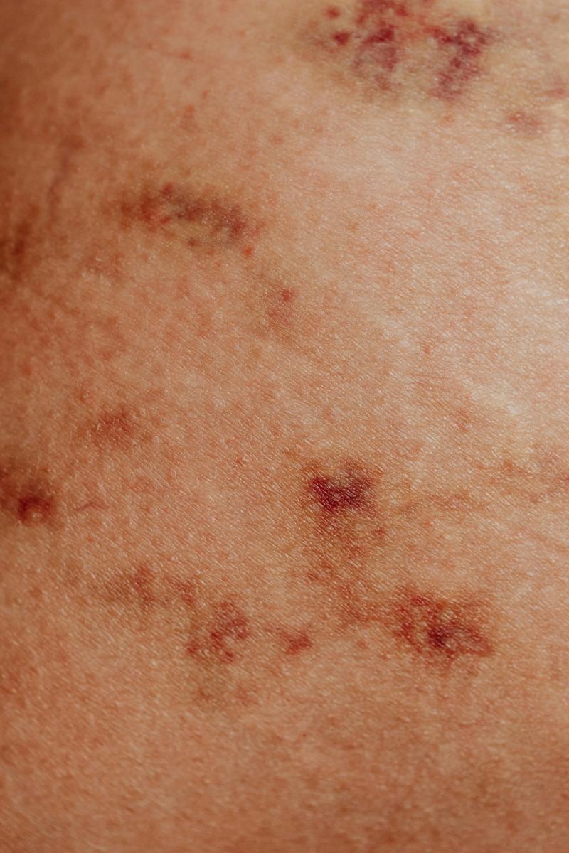 skin condition