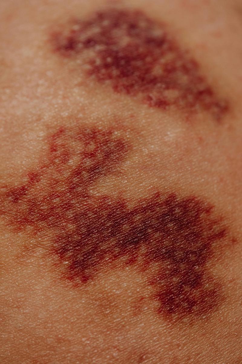 skin condition